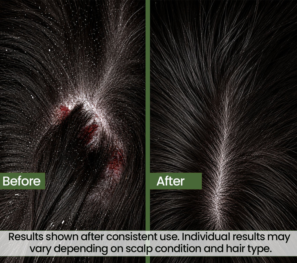 Zero Flake Pro Anti-Dandruff Shampoo | Guaranteed Visible Results