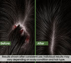 Zero Flake Pro Anti-Dandruff Shampoo | Guaranteed Visible Results