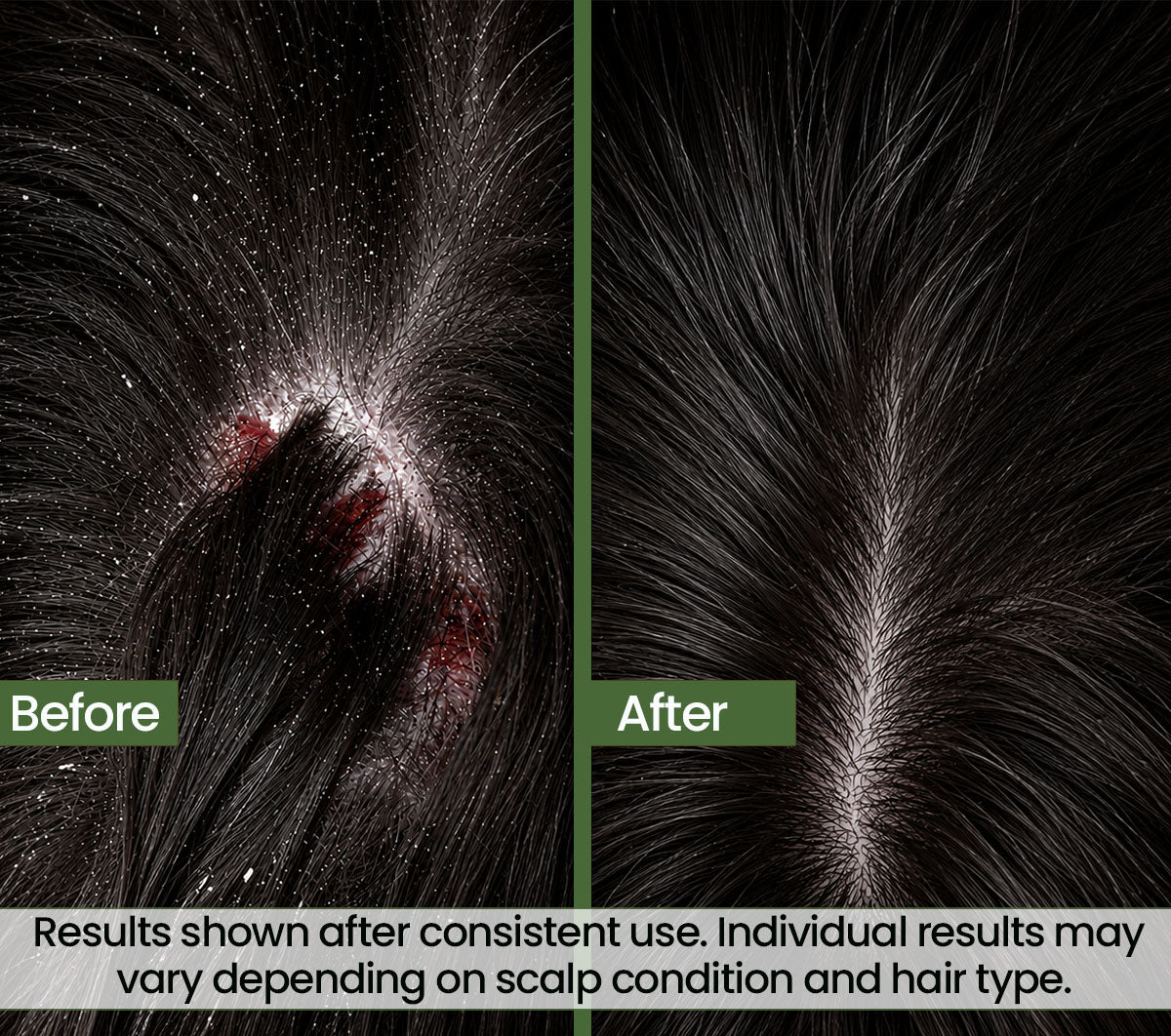Zero Flake Pro Anti-Dandruff Shampoo | Guaranteed Visible Results